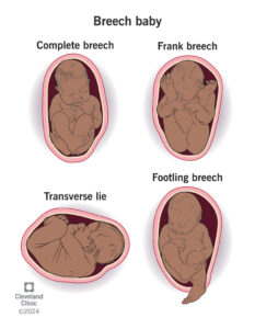 one of the most common kinds of birth injuries