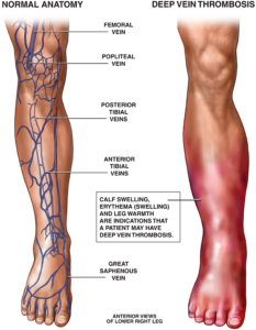 Deep Vein Thrombosis (DVT), the precursor to stroke in the recent case for Bronx stroke lawyer, Joseph M. Lichtenstein.