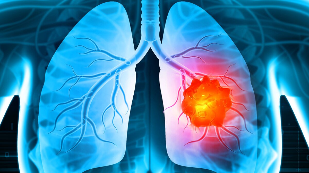 Lung Cancer Misdiagnosis Lawyer | Westchester | Upstate NY