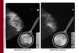 We have a history of success suing for misdiagnosis of various ailments such as cancer