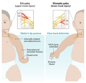 How Erb's Palsy affects your child.
